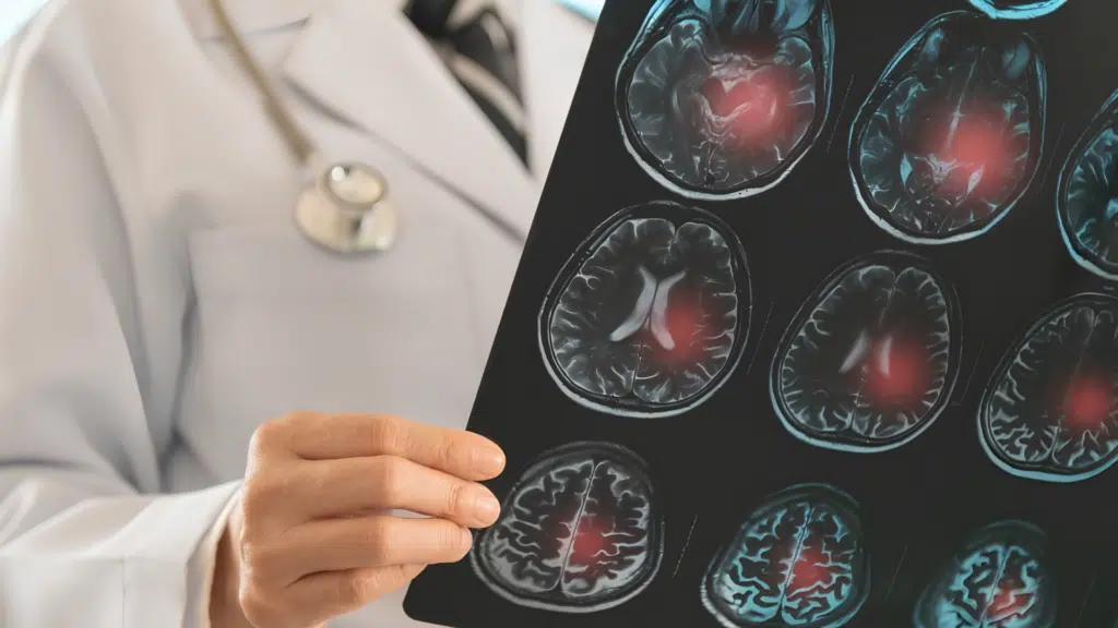 Understanding Brain Injuries Caused by Ischemic Strokes
