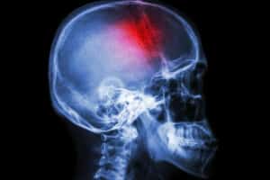 TBI Traumatic Brain Injury