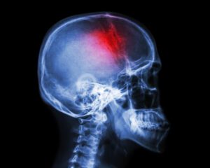 TBI Traumatic Brain Injury